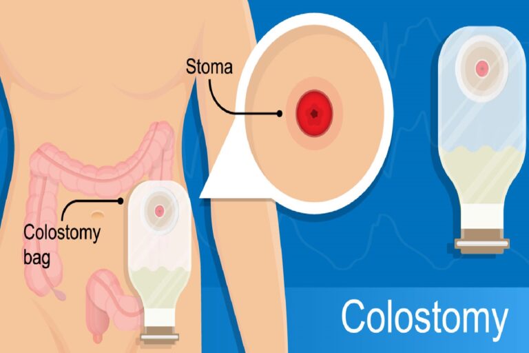 Exercise and Staying Active with a Stoma