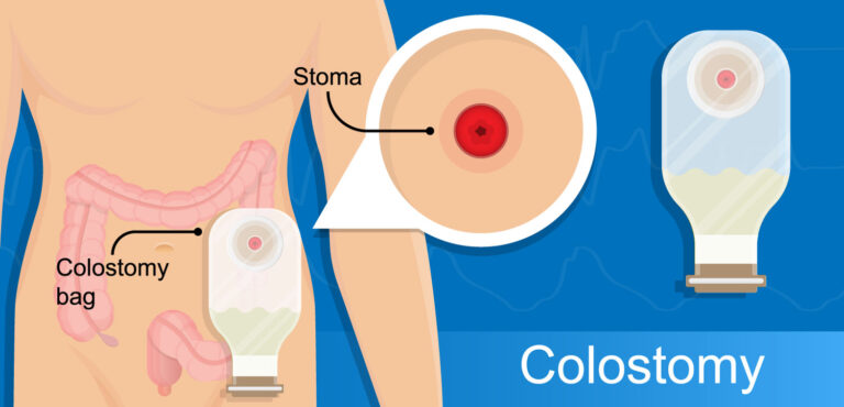 Preventing and Managing Stoma Leaks