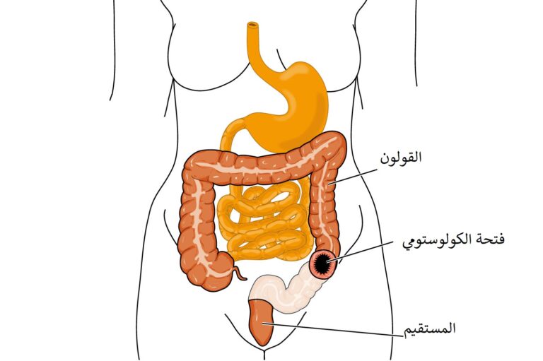 Caring for the Skin Around Your Stoma