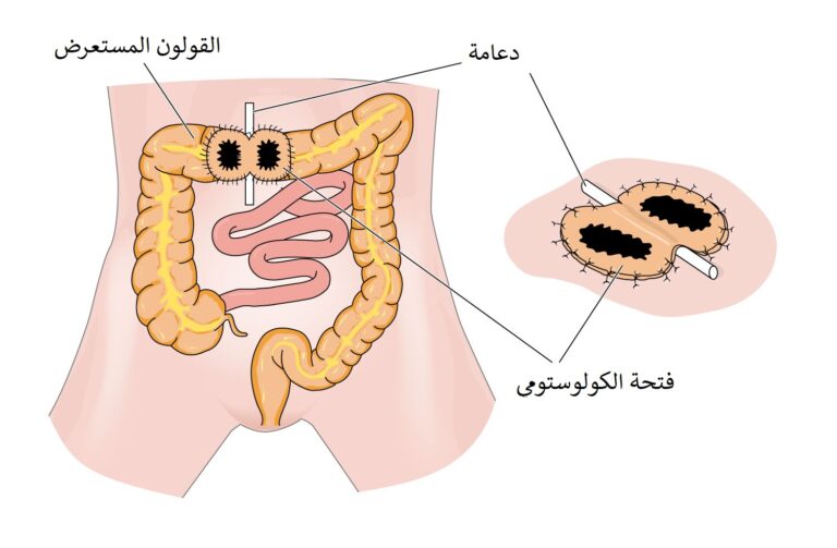 Travelling with a Stoma: A Practical Checklist