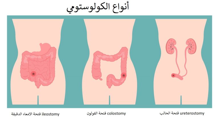 Choosing the Right Stoma Pouch